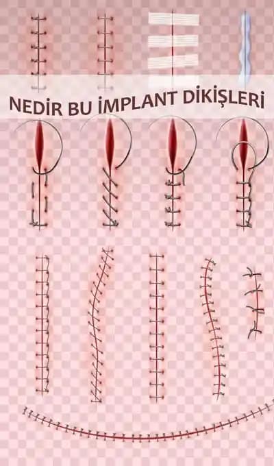 Ameliyat Sonrası Dikişleri Gizlemek İçin Yaş, Kültür ve Stil Faktörlerine Uygun Şapka Seçimi