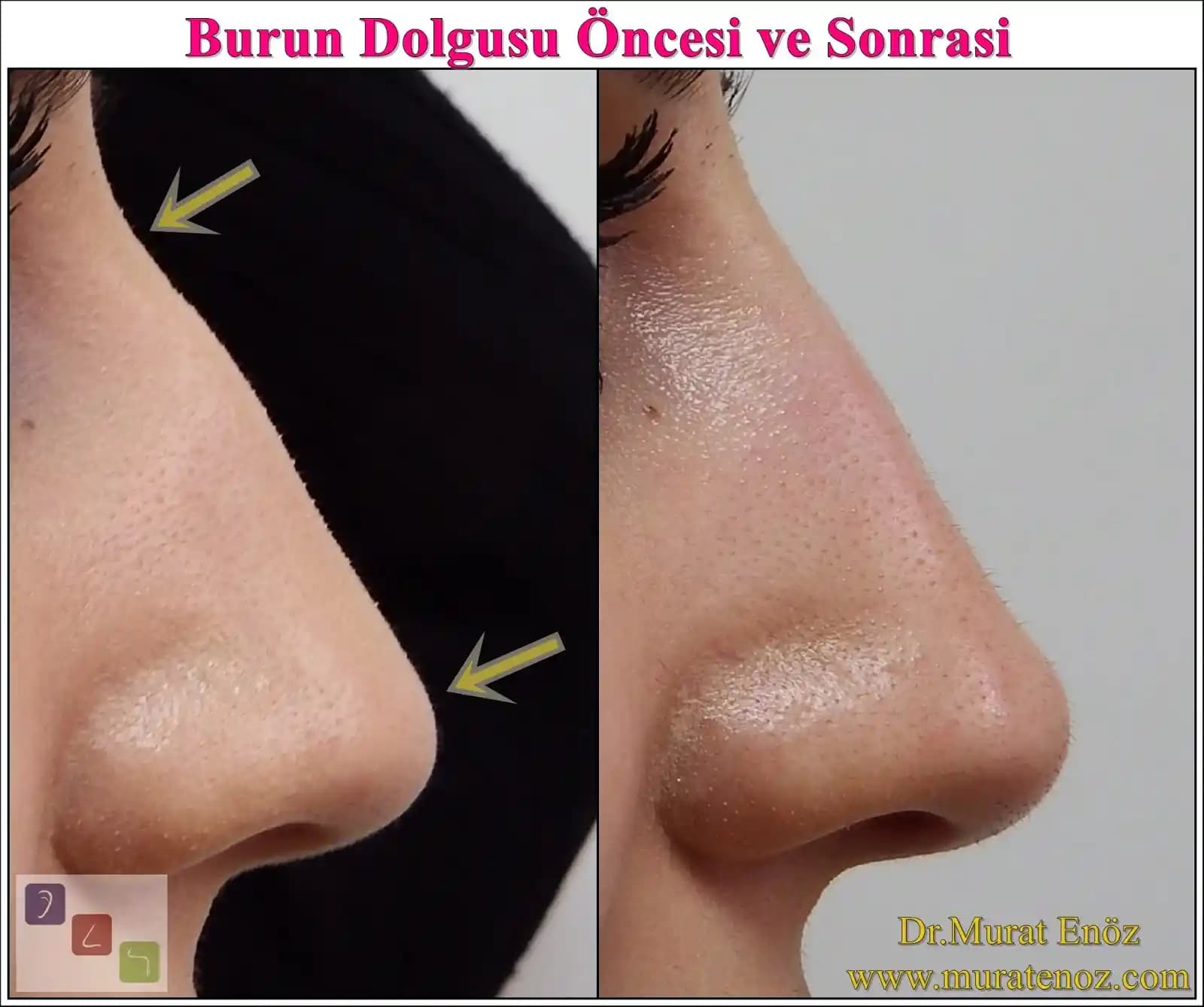 Ayakkabı Burun Dolgusu Nedir ve Ayak Sağlığı ile Estetikteki Rolü